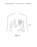 Visualization and treatment via percutaneous methods and devices diagram and image