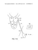 Visualization and treatment via percutaneous methods and devices diagram and image