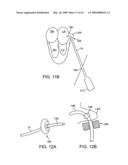 Visualization and treatment via percutaneous methods and devices diagram and image