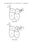 Visualization and treatment via percutaneous methods and devices diagram and image