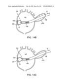 Visualization and treatment via percutaneous methods and devices diagram and image