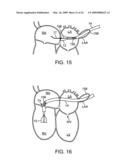 Visualization and treatment via percutaneous methods and devices diagram and image