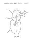 Visualization and treatment via percutaneous methods and devices diagram and image