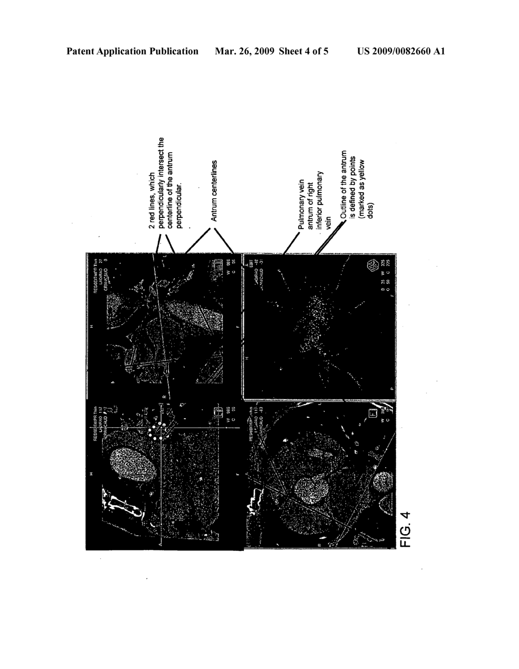 CLINICAL WORKFLOW FOR TREATMENT OF ATRIAL FIBRULATION BY ABLATION USING 3D VISUALIZATION OF PULMONARY VEIN ANTRUM IN 2D FLUOROSCOPIC IMAGES - diagram, schematic, and image 05