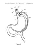 DEVICES, METHODS, AND SYSTEMS FOR SIZING OF A GASTRIC POUCH diagram and image