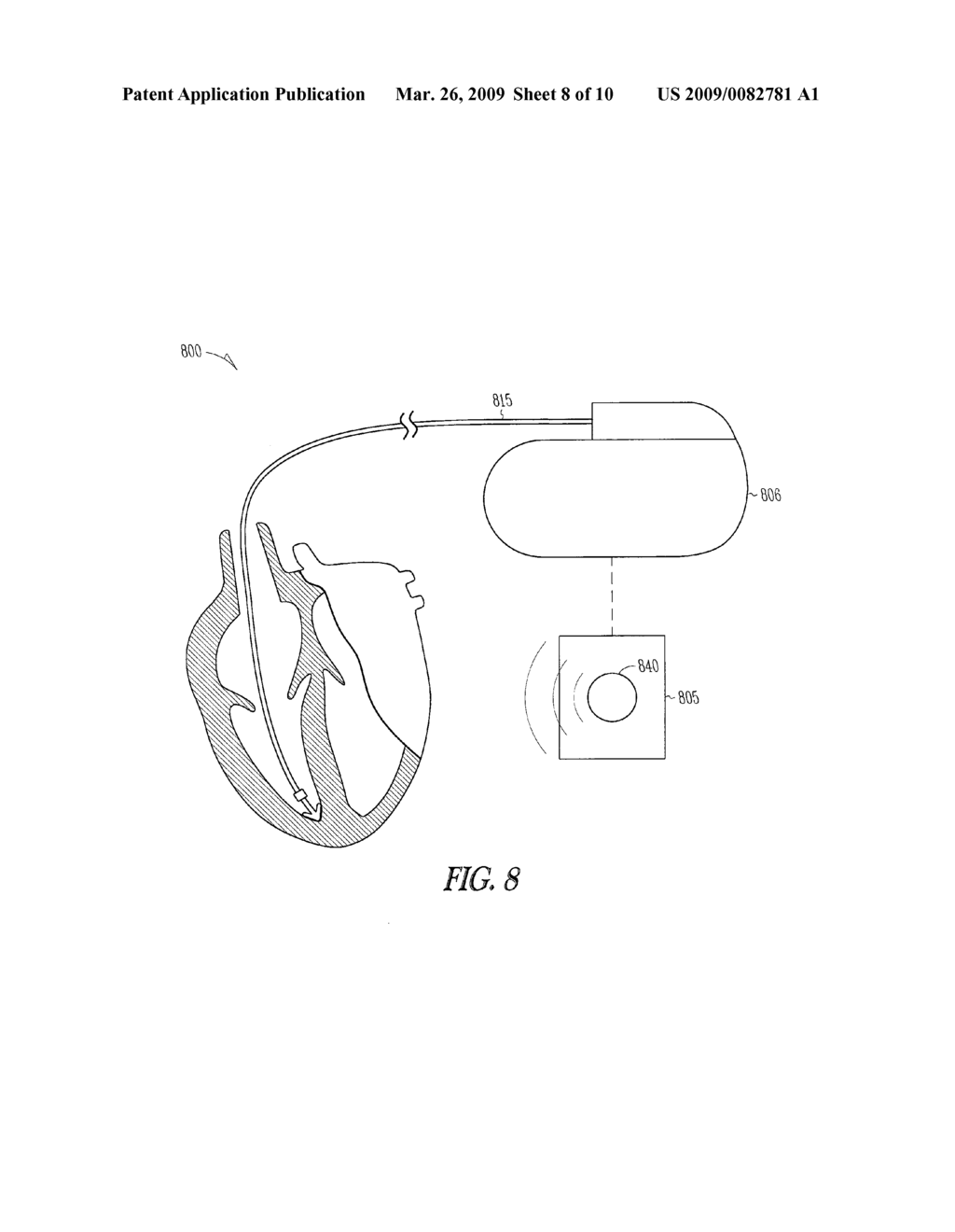 Implantable ultrasound system for maintaining vessel patency and perfusion - diagram, schematic, and image 09