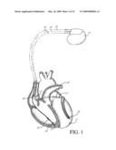 AUTOMATIC SIGNAL AMPLITUDE MEASUREMENT SYSTEM IN THE SETTING OF ABNORMAL RHYTHMS diagram and image