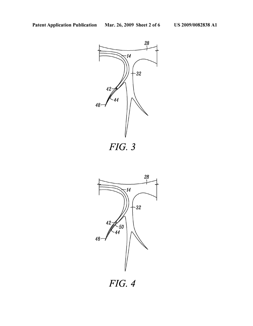 LEFT-VENTRICULAR LEAD FIXATION DEVICE IN CORONARY VEINS - diagram, schematic, and image 03