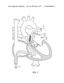 Transcatheter Delivery of a Replacement Heart Valve diagram and image