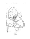 Transcatheter Delivery of a Replacement Heart Valve diagram and image