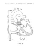 Transcatheter Delivery of a Replacement Heart Valve diagram and image