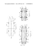 Prosthesis for restoring motion in an appendage or spinal joint and an intervertebral spacer diagram and image