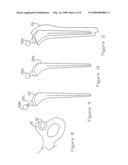 Prosthesis for restoring motion in an appendage or spinal joint and an intervertebral spacer diagram and image