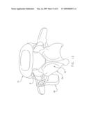 METHOD AND APPARATUS FOR SPINE JOINT REPLACEMENT diagram and image