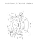 METHOD AND APPARATUS FOR SPINE JOINT REPLACEMENT diagram and image