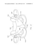 METHOD AND APPARATUS FOR SPINE JOINT REPLACEMENT diagram and image