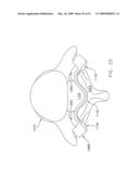 METHOD AND APPARATUS FOR SPINE JOINT REPLACEMENT diagram and image