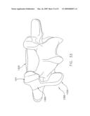 METHOD AND APPARATUS FOR SPINE JOINT REPLACEMENT diagram and image