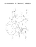 METHOD AND APPARATUS FOR SPINE JOINT REPLACEMENT diagram and image