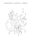 METHOD AND APPARATUS FOR SPINE JOINT REPLACEMENT diagram and image