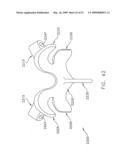 METHOD AND APPARATUS FOR SPINE JOINT REPLACEMENT diagram and image