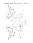 METHOD AND APPARATUS FOR SPINE JOINT REPLACEMENT diagram and image