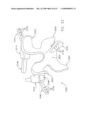 METHOD AND APPARATUS FOR SPINE JOINT REPLACEMENT diagram and image