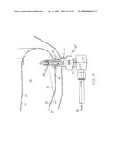 ON-WING COMBUSTOR CLEANING USING DIRECT INSERTION NOZZLE, WASH AGENT, AND PROCEDURE diagram and image