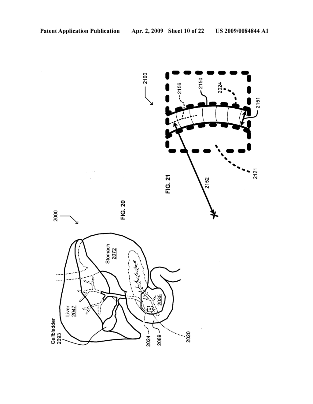 Specialty stents with flow control features or the like - diagram, schematic, and image 11