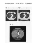 Method for recognizing and marking contrast agents in blood vessels of the lung with the aid of a CT examination and an image evaluation unit of a CT system diagram and image