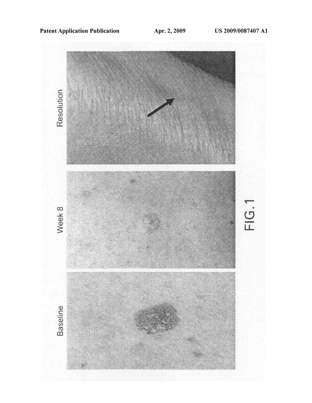 METHODS FOR THE TREATMENT OF SCLERODERMA USING 1-OXO-2-(2,6-DIOXOPIPERIDIN-3-YL)-4-METHYLISOINDOLINE - diagram, schematic, and image 02