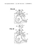 Method of accessing a bladder and associated apparatus therefor diagram and image