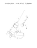 MALLEABLE SLEEVE FOR BALLOON CATHETER AND ENDOSCOPIC SURGICAL METHOD diagram and image