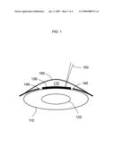 Laser-assisted thermal separation of tissue diagram and image