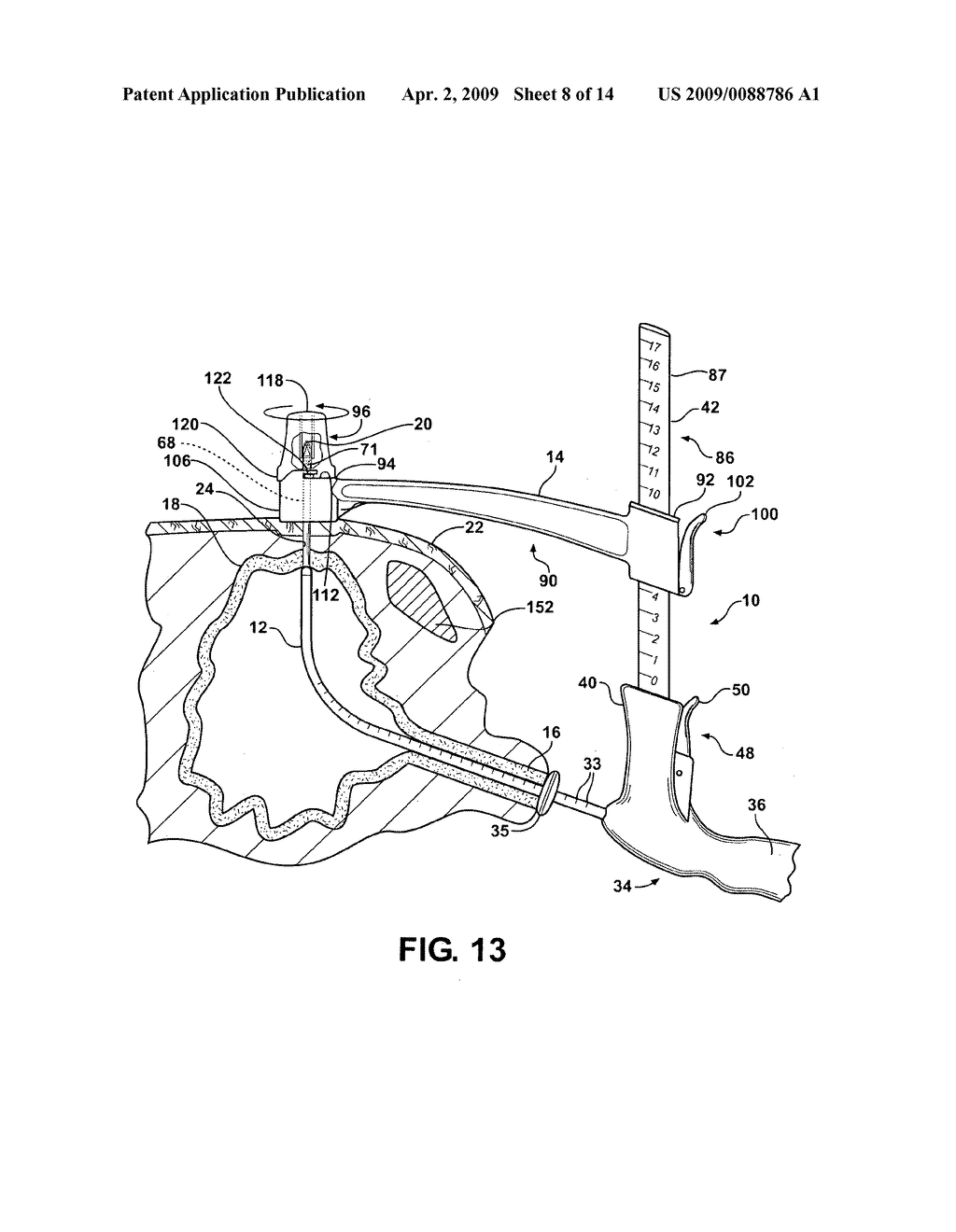 Method of Performing a Suprapubic Transurethral Cystostomy and Associated Procedures and Apparatus Therefor - diagram, schematic, and image 09