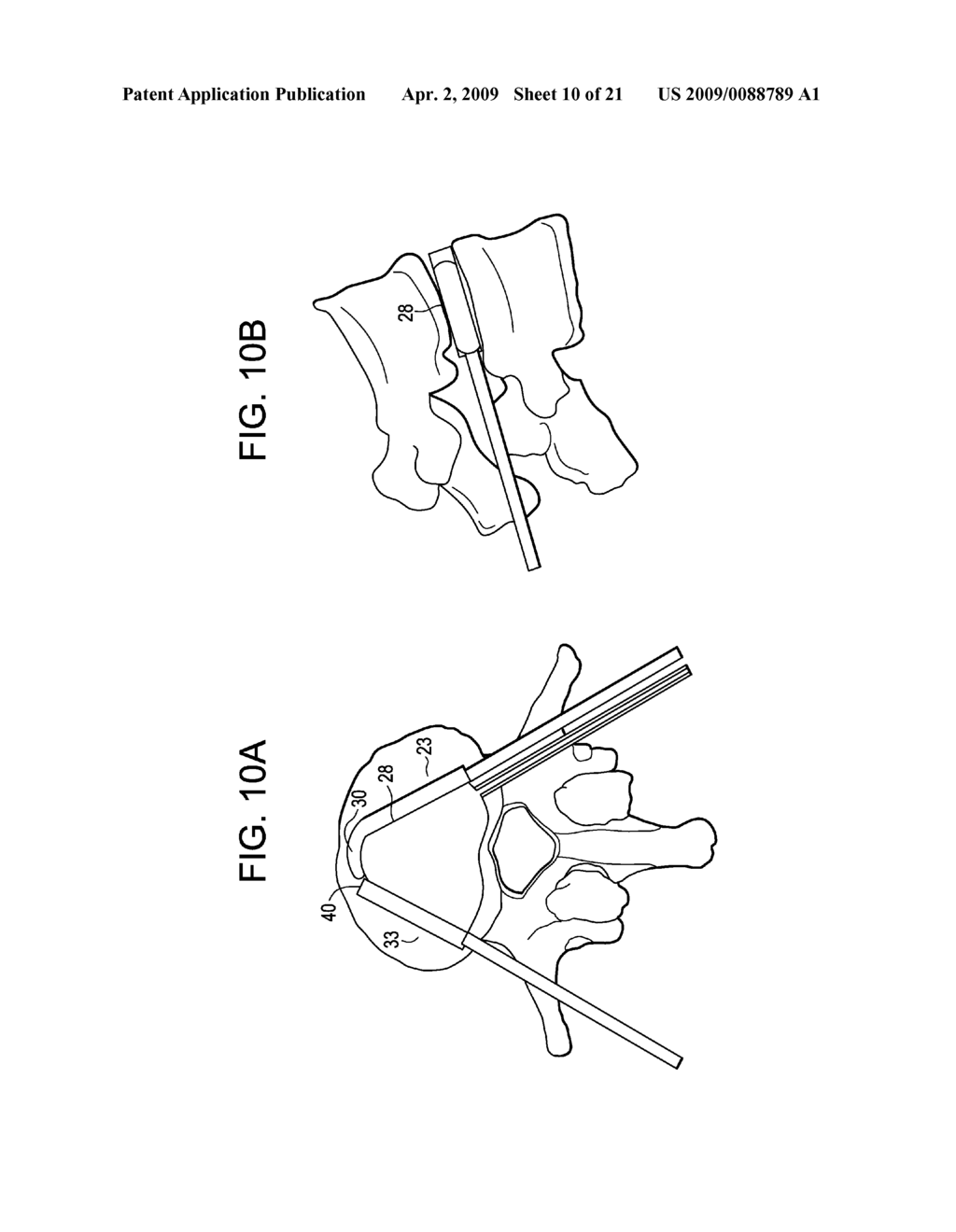 Balloon With Shape Control For Spinal Procedures - diagram, schematic, and image 11
