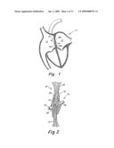 Catch Member for Septal Occluder with Adjustable-Length Center Joint diagram and image