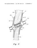 Catch Member for Septal Occluder with Adjustable-Length Center Joint diagram and image