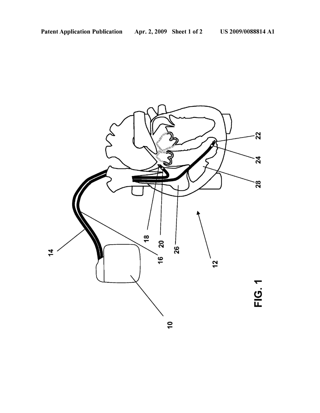 HEART STIMULATING SYSTEM - diagram, schematic, and image 02