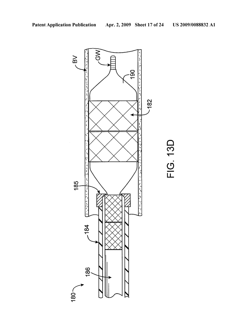 APPARATUS AND METHODS FOR DELIVERY OF VARIABLE LENGTH STENTS - diagram, schematic, and image 18