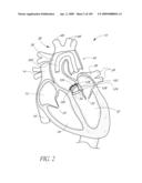 TRANSLUMENALLY IMPLANTABLE HEART VALVE WITH FORMED IN PLACE SUPPORT diagram and image