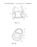 TRANSLUMENALLY IMPLANTABLE HEART VALVE WITH FORMED IN PLACE SUPPORT diagram and image