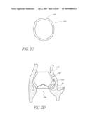 TRANSLUMENALLY IMPLANTABLE HEART VALVE WITH FORMED IN PLACE SUPPORT diagram and image