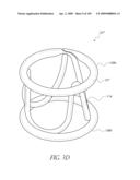 TRANSLUMENALLY IMPLANTABLE HEART VALVE WITH FORMED IN PLACE SUPPORT diagram and image