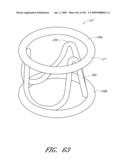 TRANSLUMENALLY IMPLANTABLE HEART VALVE WITH FORMED IN PLACE SUPPORT diagram and image