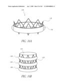 TRANSLUMENALLY IMPLANTABLE HEART VALVE WITH FORMED IN PLACE SUPPORT diagram and image