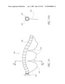 TRANSLUMENALLY IMPLANTABLE HEART VALVE WITH FORMED IN PLACE SUPPORT diagram and image