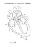 TRANSLUMENALLY IMPLANTABLE HEART VALVE WITH FORMED IN PLACE SUPPORT diagram and image