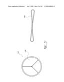 TRANSLUMENALLY IMPLANTABLE HEART VALVE WITH FORMED IN PLACE SUPPORT diagram and image