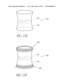 TRANSLUMENALLY IMPLANTABLE HEART VALVE WITH FORMED IN PLACE SUPPORT diagram and image